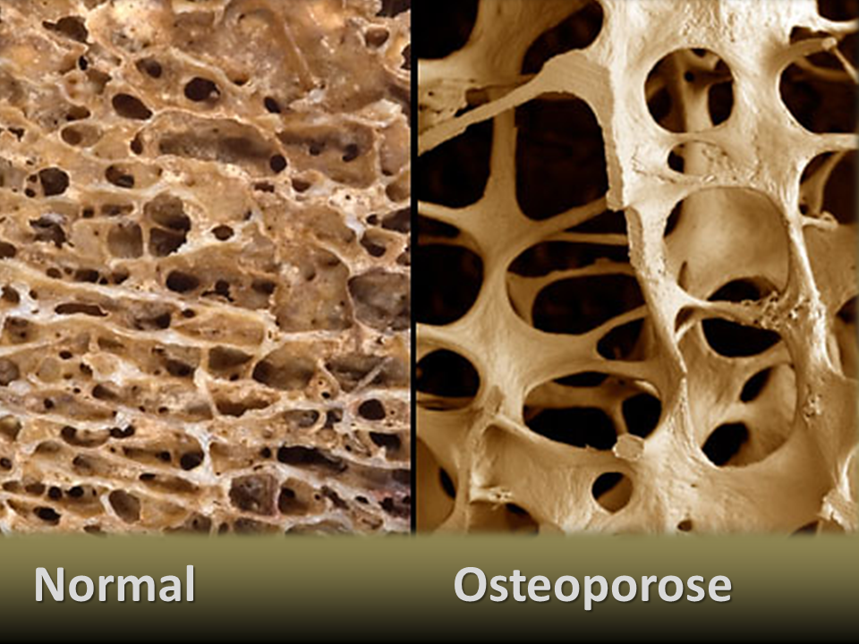 Osteoporose.png