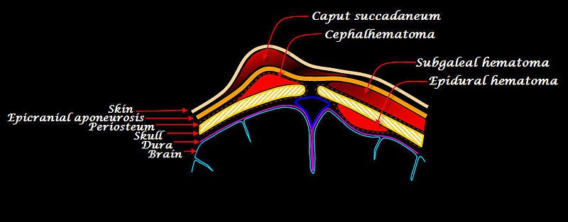 Scalp hematomas.jpg