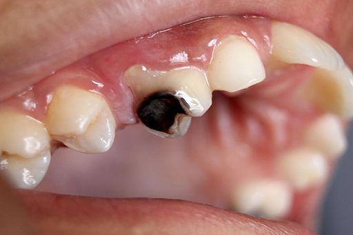 Dental Caries Cavity.JPG