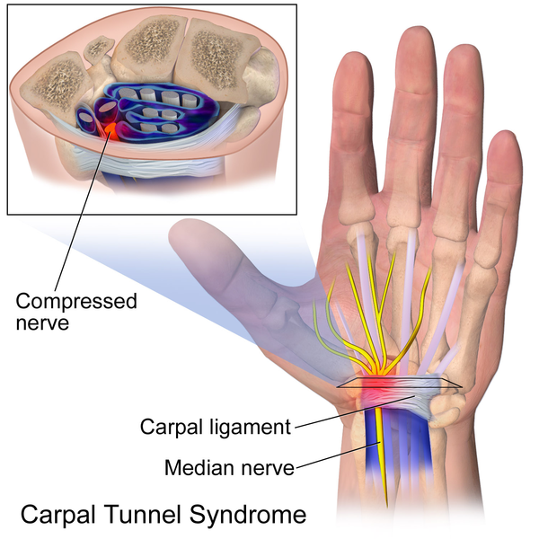 Carpal Tunnel Syndrome.png