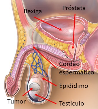 Cancro testicular.jpg