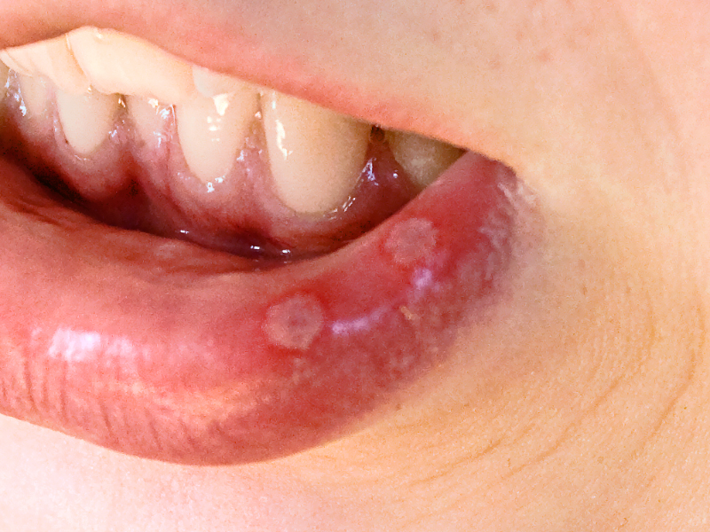 Aphthous ulcers on lip.jpg