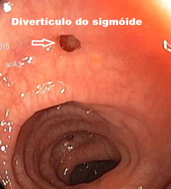 Diverticulose.png