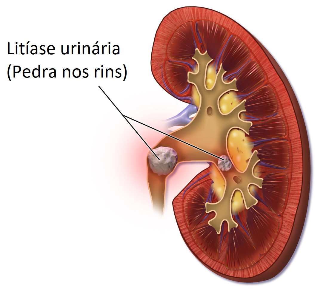 Litiase urinaria.png